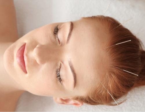 Acupunctura